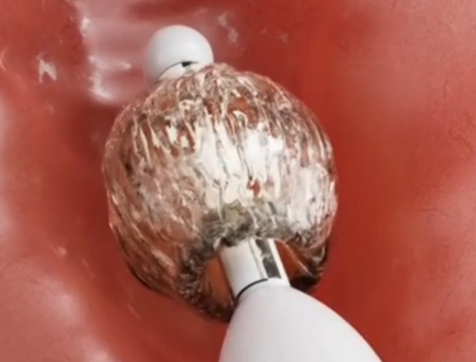 AETIA 專研球囊助推器展開狀態